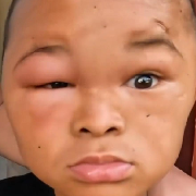 风油精去桂头淤泥